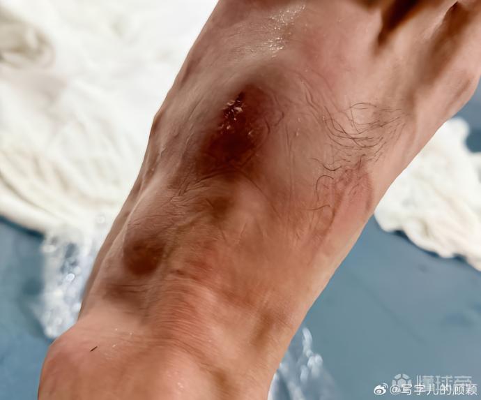 记者:谢维军膝盖内侧副韧带受伤,复出困难